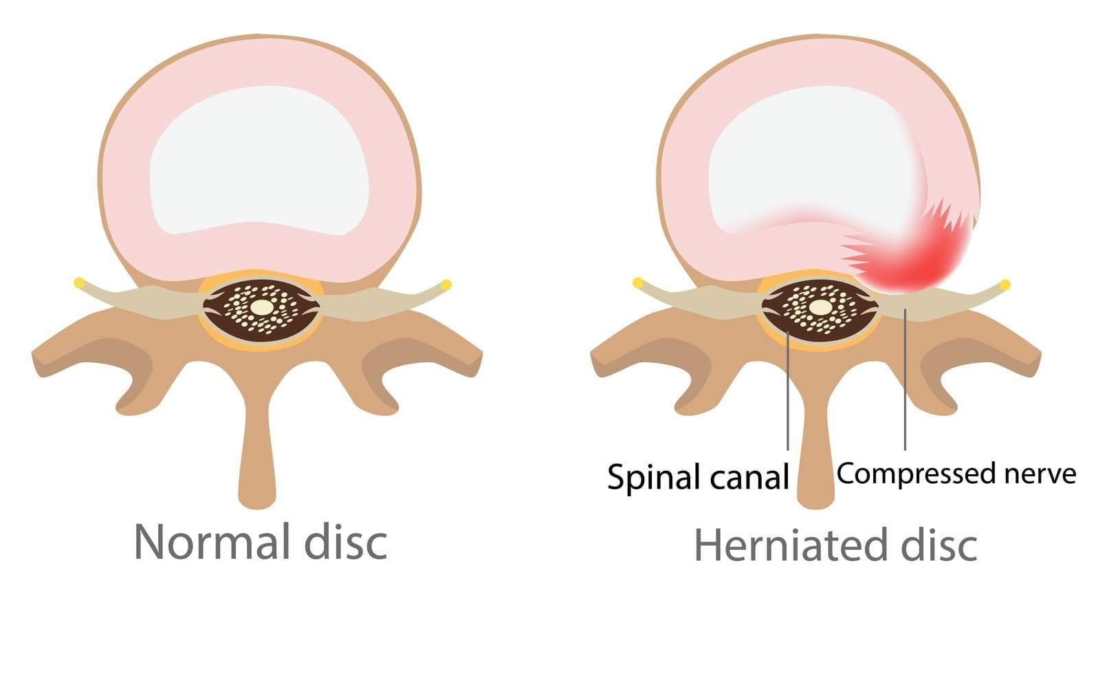 Lumbar Disc Injuries